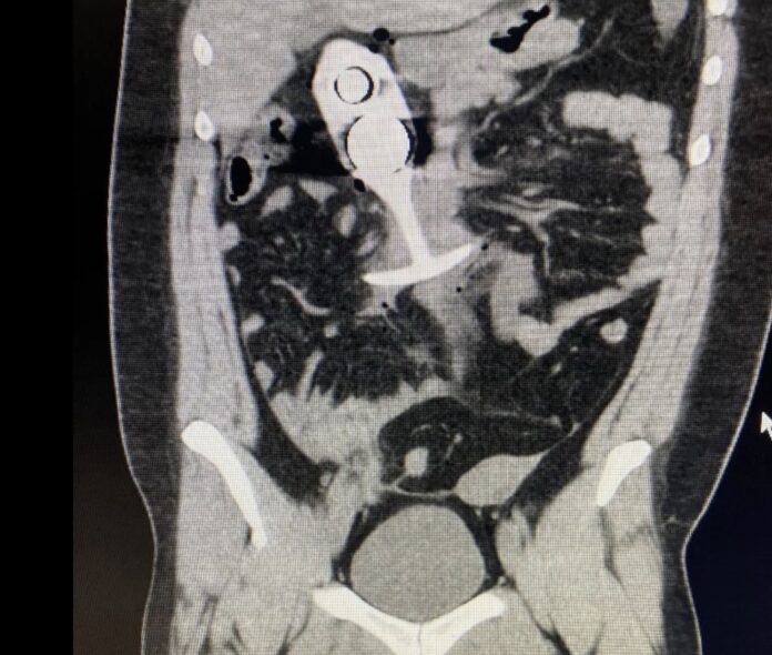 plug anal sextoy irm mri butt plug anal sextoy irm mri butt