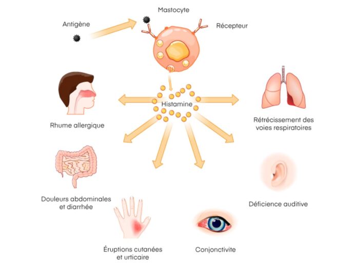 histamine intoxication