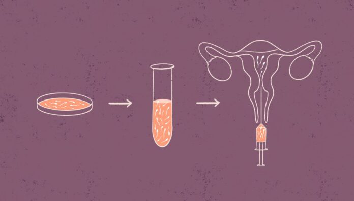 insimenation intra-uterine insimenation intra-uterine